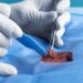 Primul transplant de ficat pentru cancer de colon avansat din Marea Britanie: Un progres medical impresionant